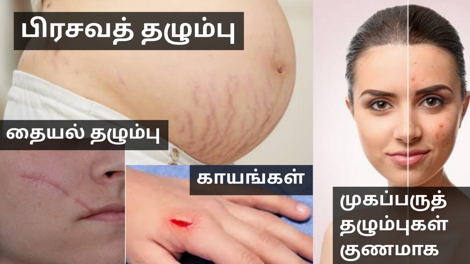 உடலில் உள்ள தழும்புகள் முழுவதும் மறைய வீட்டு வைத்தியம் | Home remedy for remove acne scars marks
