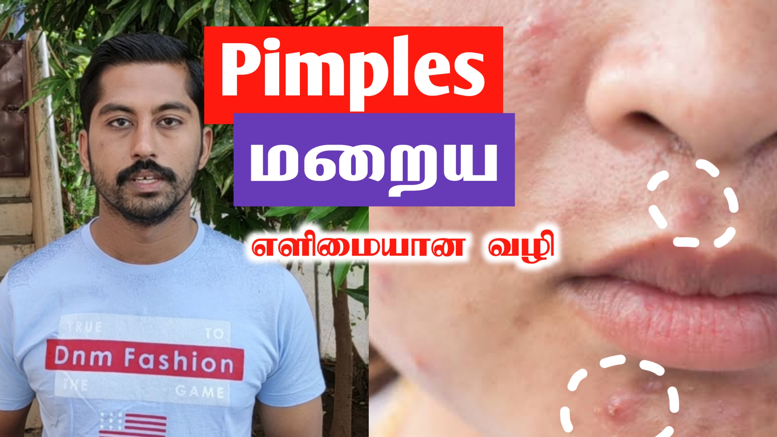 முகப்பரு நீங்க இயற்கை வழி | முகப்பரு தழும்புகள் மறைய | Pimples removal on face at home | Nextday360