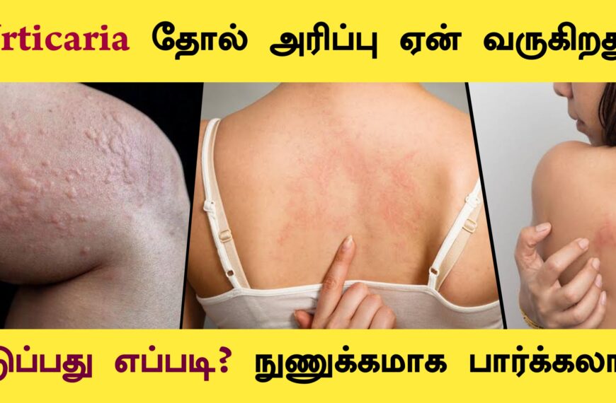 Urticaria – causes in tamil | Skin Rashes | Allergy | Hives| Next Day 360